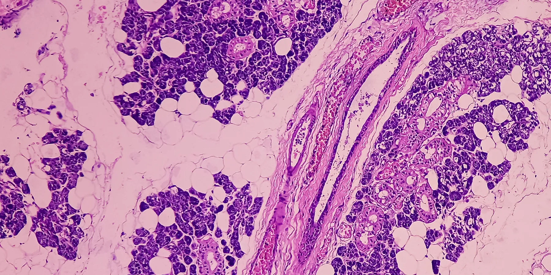 Microscopic view of parotid cancer tissue biopsy.