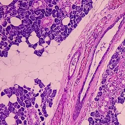 Microscopic view of parotid cancer tissue biopsy.