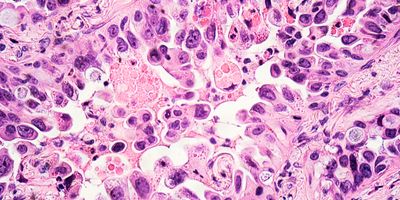 A microscopic image of a lung cancer tissue biopsy showing stained tumor cells.