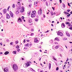 A microscopic image of a lung cancer tissue biopsy showing stained tumor cells.