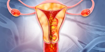 Graphical illustration of a female reproductive system with cancerous growth on the endometrial lining of the uterus.