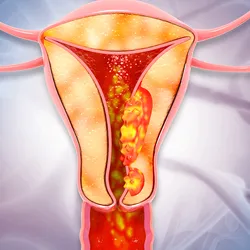Graphical illustration of a female reproductive system with cancerous growth on the endometrial lining of the uterus.