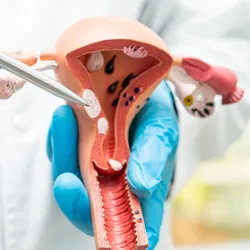 A clinician with gloved hands points with a pen to a model of the female reproductive system with tumors in the uterine wall.