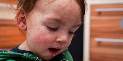 Photo of a baby's face covered with the measles rash.