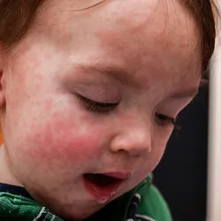 Photo of a baby's face covered with the measles rash.