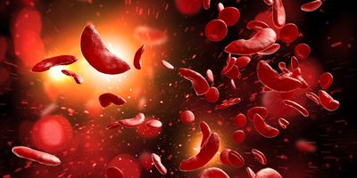 A 3D illustration of sickle-shaped red blood cells in the bloodstream seen in sickle cell disease.