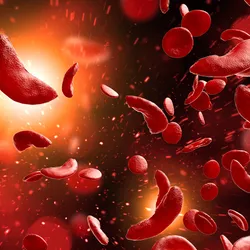 A 3D illustration of sickle-shaped red blood cells in the bloodstream seen in sickle cell disease.
