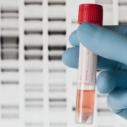 Photo of a laboratory professional holding up a test tube in front of a DNA electrophoresis gel of a genetic test for markers of gestational diabetes.