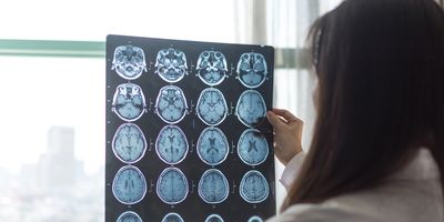 Photo of a clinician holding up a MRI digital x-ray of the human brain tumor in front of a oncology lab window.