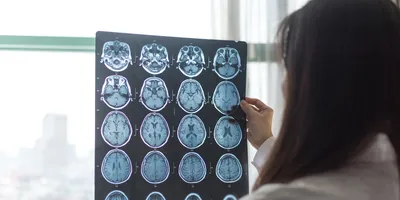 Photo of a clinician holding up a MRI digital x-ray of the human brain tumor in front of a oncology lab window.