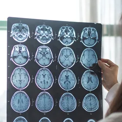 Photo of a clinician holding up a MRI digital x-ray of the human brain tumor in front of a oncology lab window.