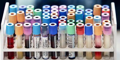 Photo of several laboratory blood sample tubes in a rack on a clinical laboratory bench.