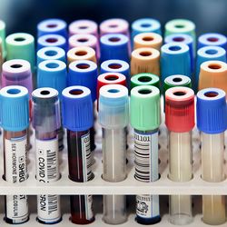 Photo of several laboratory blood sample tubes in a rack on a clinical laboratory bench.