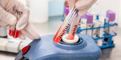  Clinical laboratory scientist loading prepping a patient sample for a clinical flow cytometry experiment.
