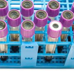  Photo of blood sample tubes in rack on white clinical laboratory bench.