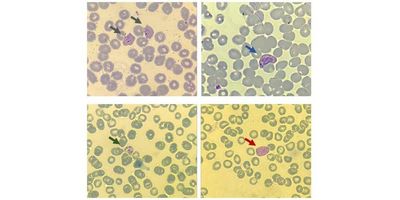  In these illustrative images of Plasmodium vivax, arrows point to the asexual stages of the parasite as seen in blood smears—ring (gray), trophozoite (blue), and schizont (green)—as well as the sexual stage known as the gametocyte (red) .
