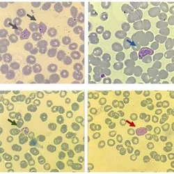  In these illustrative images of Plasmodium vivax, arrows point to the asexual stages of the parasite as seen in blood smears—ring (gray), trophozoite (blue), and schizont (green)—as well as the sexual stage known as the gametocyte (red) .