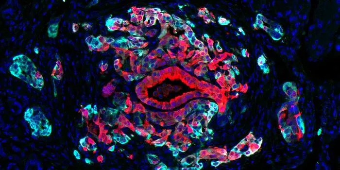 Pancreas cancer harbors cells in different states, with classical cells (red) and basal cells (turquoise) co-existing within individual tumors. Basal cells, which typically are associated with aggressive disease, show increased sensitivity to KRAS inhibitors, a promising new drug class for pancreatic cancer.