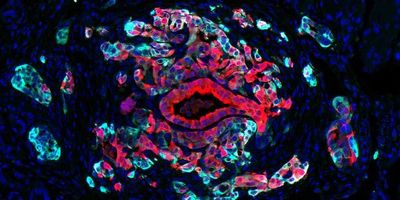 Pancreas cancer harbors cells in different states, with classical cells (red) and basal cells (turquoise) co-existing within individual tumors. Basal cells, which typically are associated with aggressive disease, show increased sensitivity to KRAS inhibitors, a promising new drug class for pancreatic cancer.