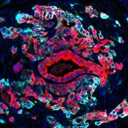 Pancreas cancer harbors cells in different states, with classical cells (red) and basal cells (turquoise) co-existing within individual tumors. Basal cells, which typically are associated with aggressive disease, show increased sensitivity to KRAS inhibitors, a promising new drug class for pancreatic cancer.