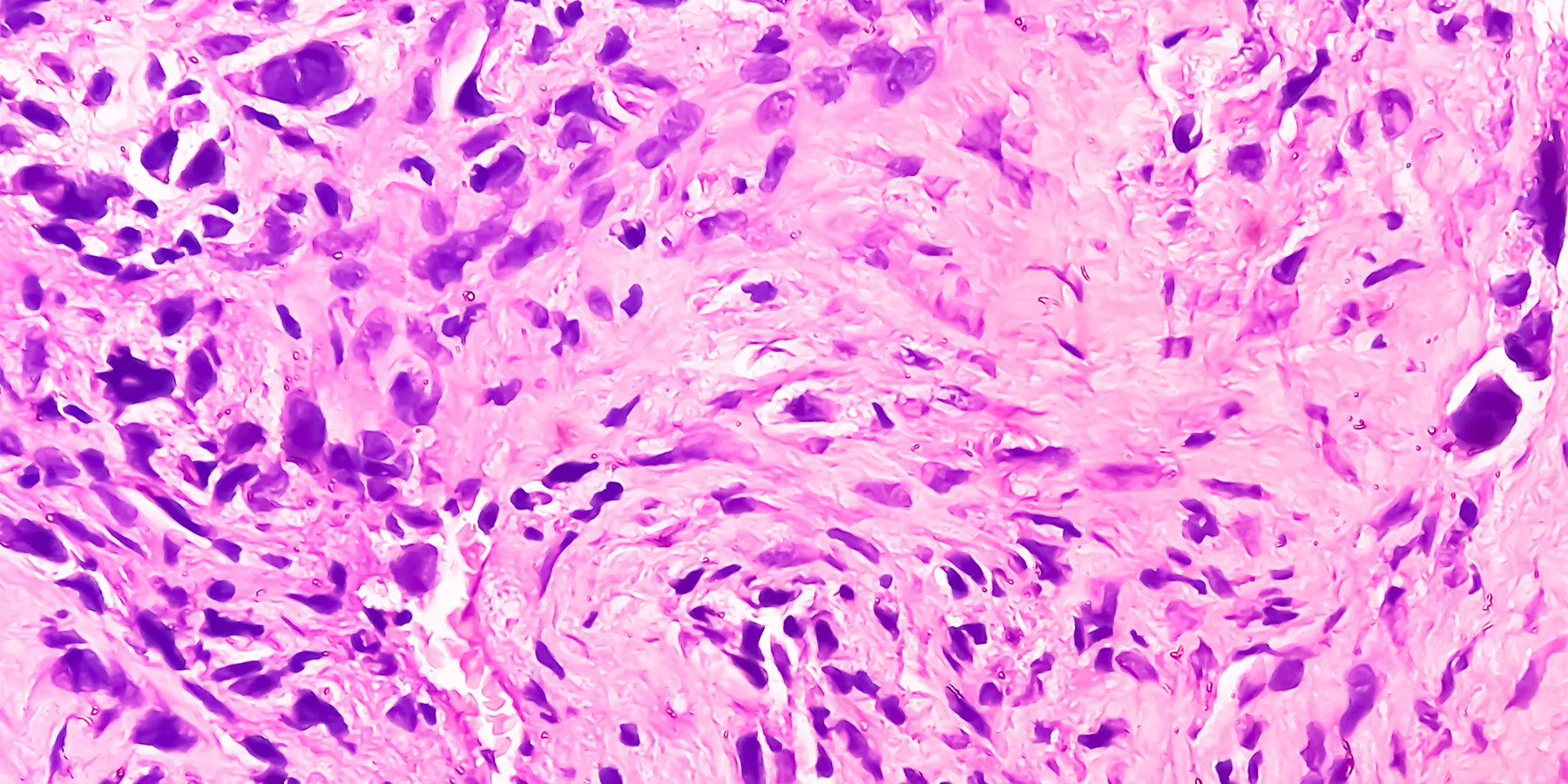 Photo of histology slide of chondroblastic osteosarcoma, a very rare cancer.