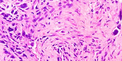 Photo of histology slide of chondroblastic osteosarcoma, a very rare cancer.