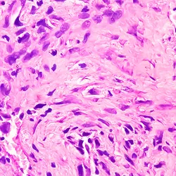 Photo of histology slide of chondroblastic osteosarcoma, a very rare cancer.