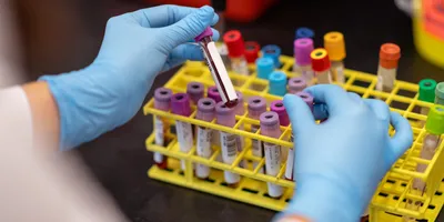 ALS Diagnosis and Survival Linked to Metals in Blood, Urine | Today's ...