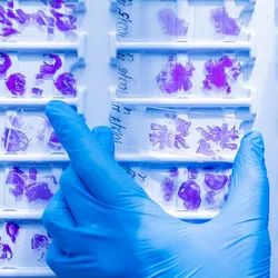 Photo of a clinical lab professional’s hand wearing a blue globe and holding a histology lung cancer slide.