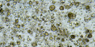 Microscope image of 3D organoids cultured from esophageal cancer.