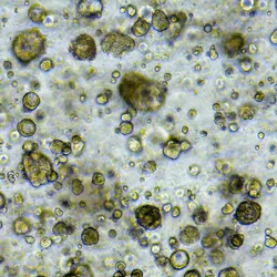 Microscope image of 3D organoids cultured from esophageal cancer.
