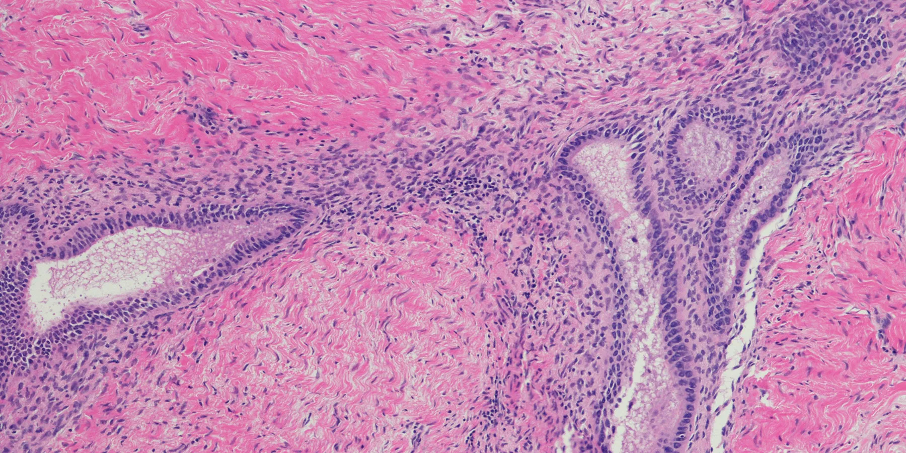 Photo of a micrograph of endometriosis stained tissue section in a patient with BRCA1 mutation.
