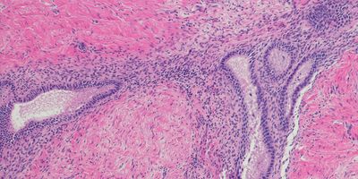 Photo of a micrograph of endometriosis stained tissue section in a patient with BRCA1 mutation.