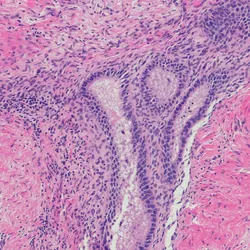 Photo of a micrograph of endometriosis stained tissue section in a patient with BRCA1 mutation.