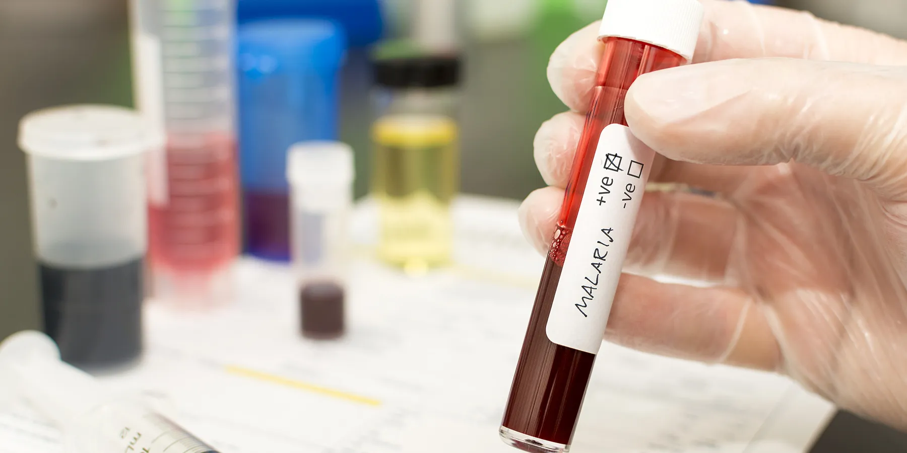 noninvasive-malaria-test-could-be-global-game-changer Photo of a clinical lab professional’s gloved hand holding a tube of a blood sample positive for malaria.