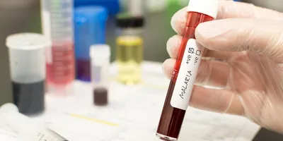 Photo of a clinical lab professional’s gloved hand holding a tube of a blood sample positive for malaria.