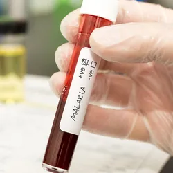 Photo of a clinical lab professional’s gloved hand holding a tube of a blood sample positive for malaria.