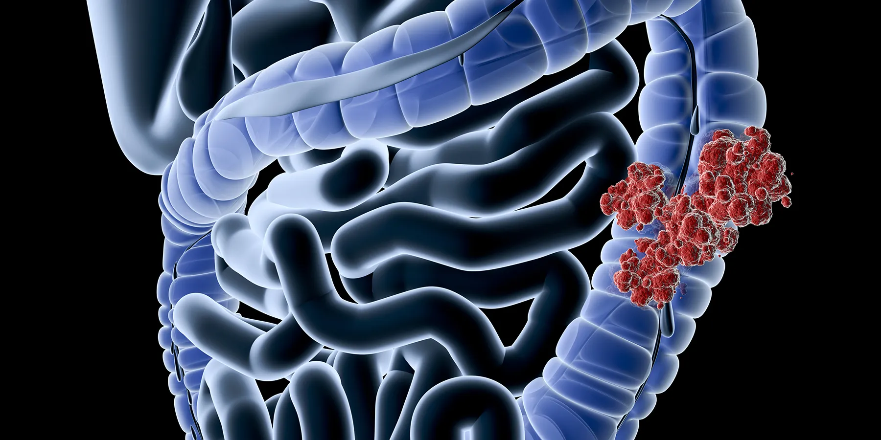in-five-cancer-types-prevention-and-screening-have-been-major-contributors-to-saving-lives Illustration of colorectal tumor cancer cells on a representative drawing of major organs inside the human body against a black background.