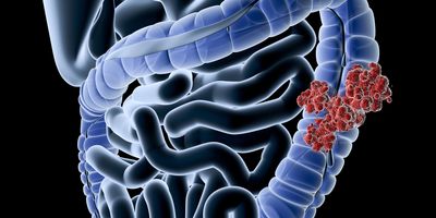  Illustration of colorectal tumor cancer cells on a representative drawing of major organs inside the human body against a black background.