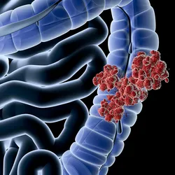 Illustration of colorectal tumor cancer cells on a representative drawing of major organs inside the human body against a black background.