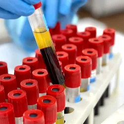  Photo of a clinical laboratory worker’s gloved hand picking up a blood tube sample to test for lymphoma.