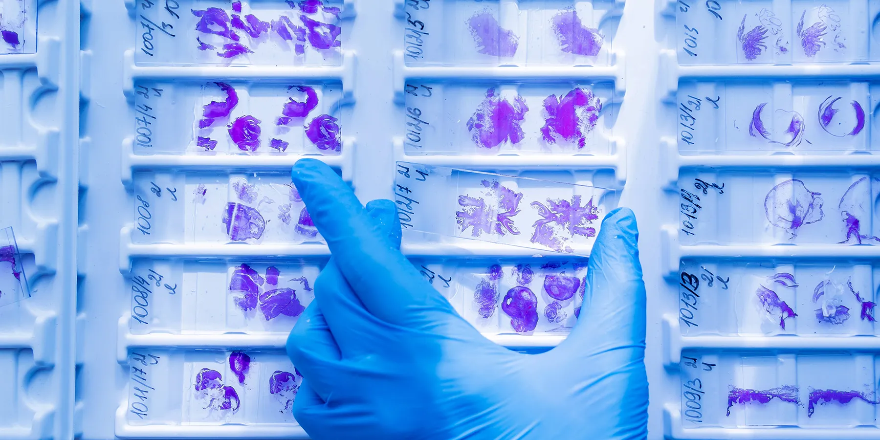 Photo of the hand of a clinical lab professional wearing a blue glove and holding a cancer histology slide stained for biomarkers among a background of other slides.