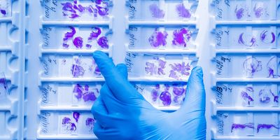 Photo of the hand of a clinical lab professional wearing a blue glove and holding a cancer histology slide stained for biomarkers among a background of other slides.