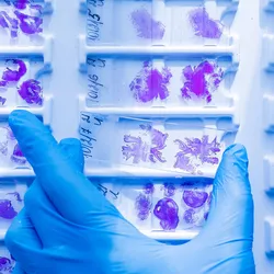 Photo of the hand of a clinical lab professional wearing a blue glove and holding a cancer histology slide stained for biomarkers among a background of other slides.