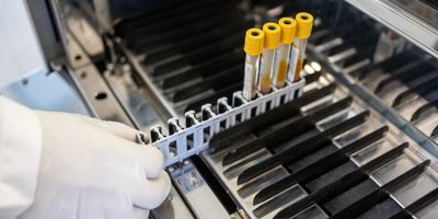 Photo of a clinical lab professional wearing a white lab coat and gloves loading blood samples from myelodysplastic syndrome patients for lab testing.