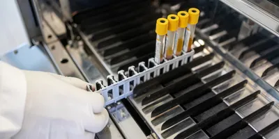 Photo of a clinical lab professional wearing a white lab coat and gloves loading blood samples from myelodysplastic syndrome patients for lab testing.