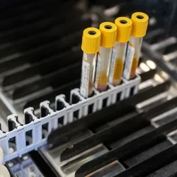 Photo of a clinical lab professional wearing a white lab coat and gloves loading blood samples from myelodysplastic syndrome patients for lab testing.