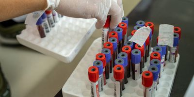 Photo of blood sample collection tubes filled with blood samples from pregnant woman diagnosed with cancer during pregnancy