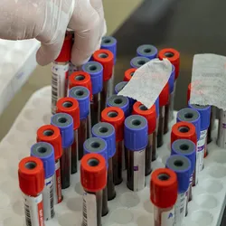 Photo of blood sample collection tubes filled with blood samples from pregnant woman diagnosed with cancer during pregnancy