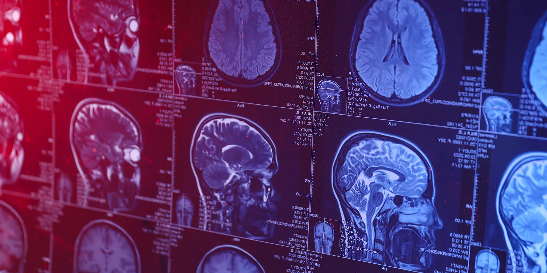 Photo of an MRI of the human head and brain.